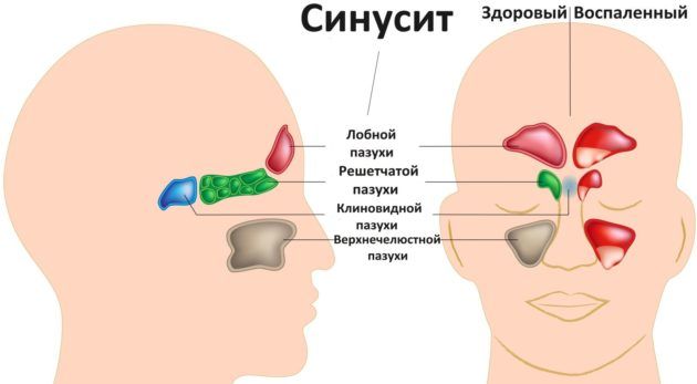 Синусит