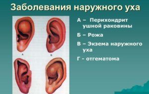 Онкология уха