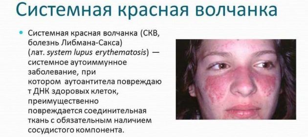 Болезнь Либмана-Сакса