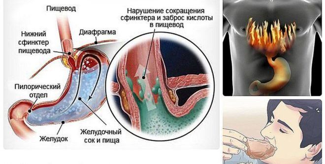Описание эзофагита