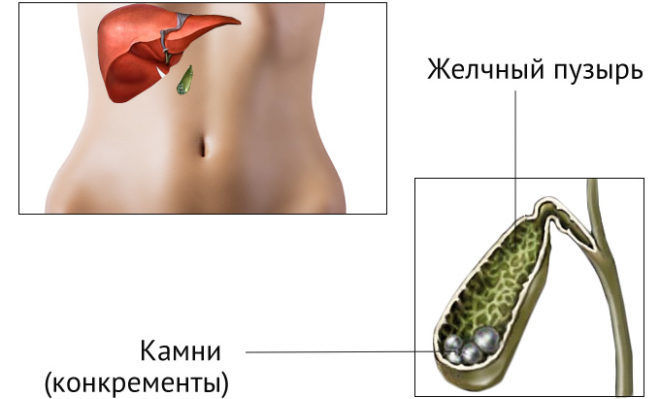 Желчнокаменная болезнь