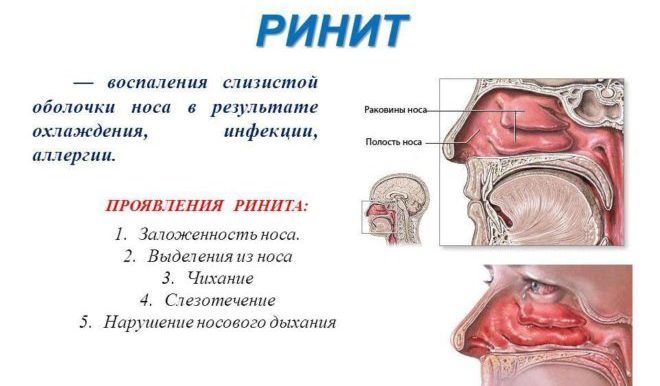 Ринит