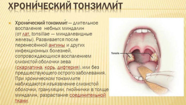Хроническая форма ангины