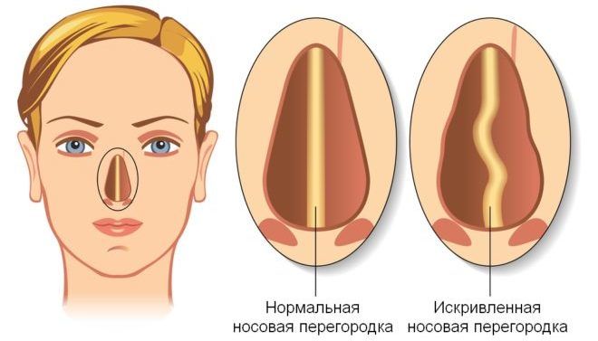 Искривление носовой перегородки ведет за собой потерю обоняния