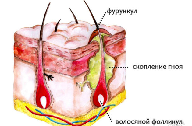 Гнойный ринит
