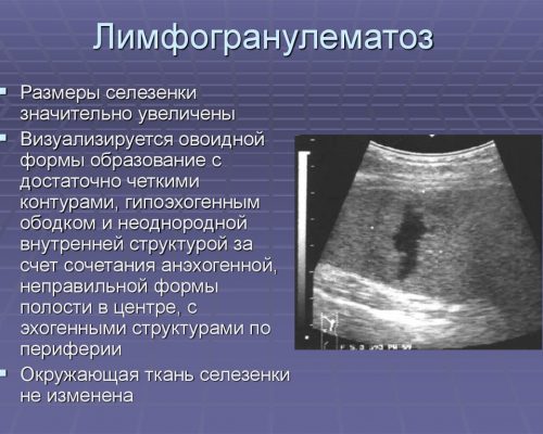 Лимфогранулематоз