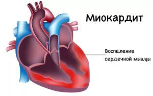 Ревматический миокардит