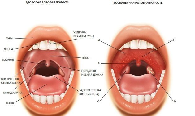Тонзиллит