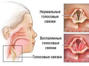 Ларингит
