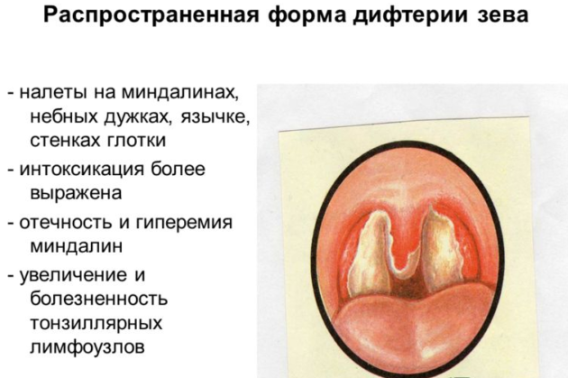 Дифтерия глотки