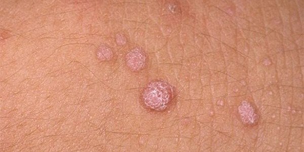 Средства для лечения папиллом