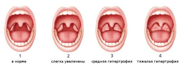 Степени разрастания аденоидов