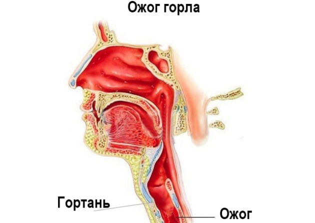 Травма гортани