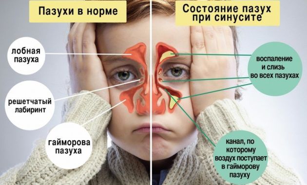 Синусит