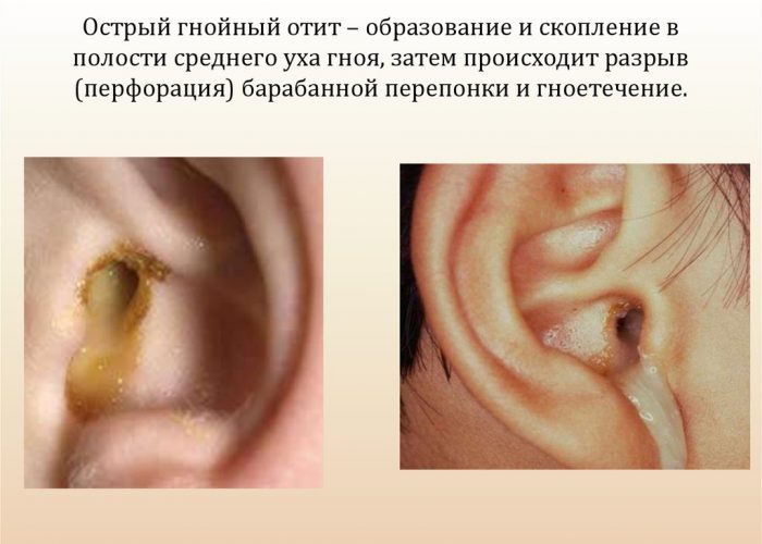 Острый гнойный отит Острый гнойный отит