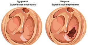 Барабанная перепонка при баротравме