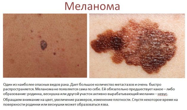 Появление онкопроцесса подвержено лицо,нос, лоб, уголки глаз, губ, уши