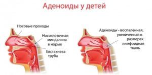 Аденоиды у детей
