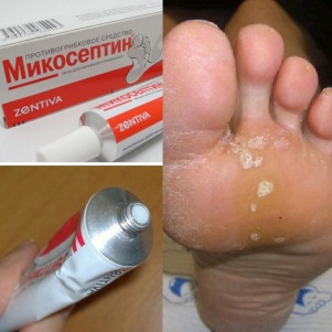 Лечение грибковых заболеваний мазью Микосептин