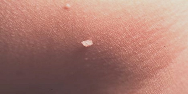 Вирус папилломы человека 18 типа