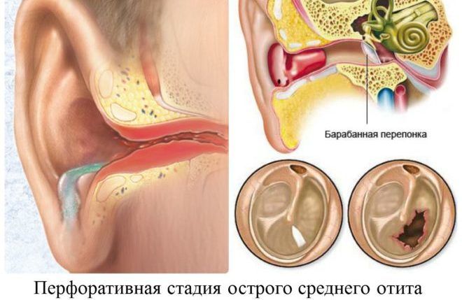 Отит