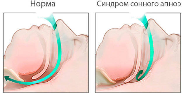 Апноэ
