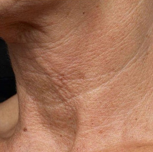Что такое кольца Венеры и как от них избавиться