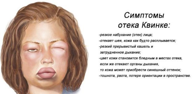 Отек квинке