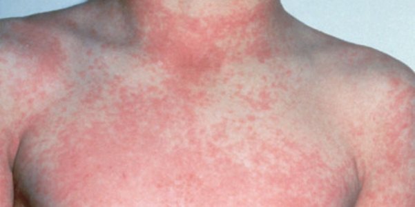 Применение народных средств от крапивницы