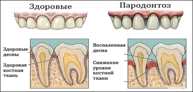Пародонтоз