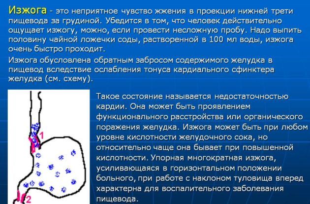Изжога
