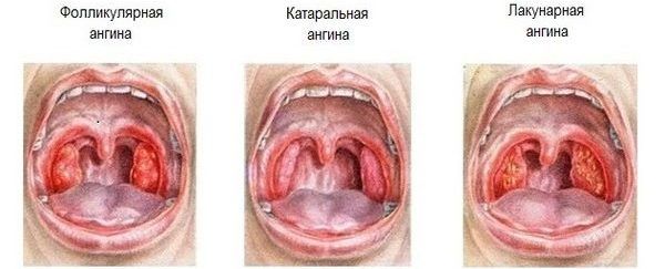 Виды ангины