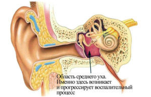 Воспаление уха