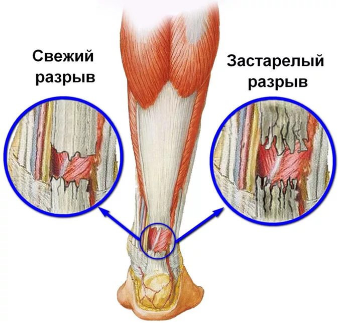 Свежий и застарелый разрыв сухожилий