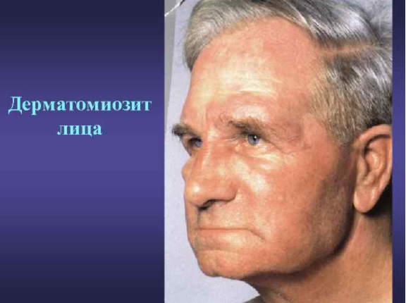 Дерматомиозит: причины, симптомы, классификация