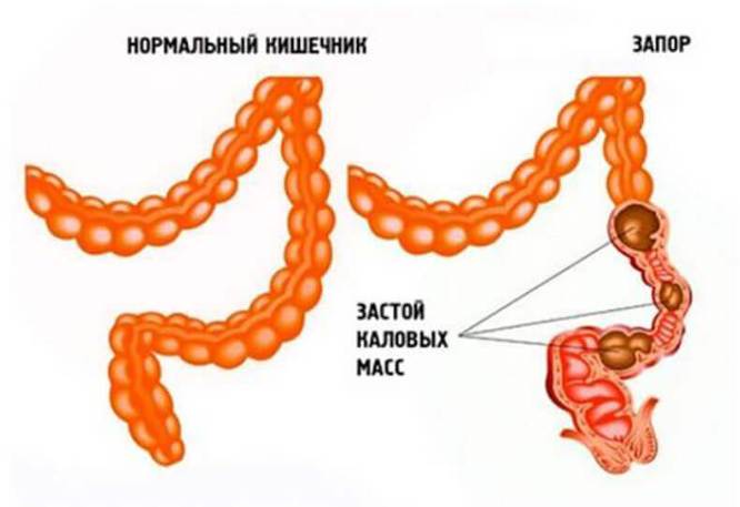 Запор - определение и виды