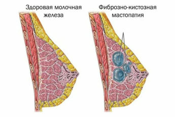 Фиброз груди