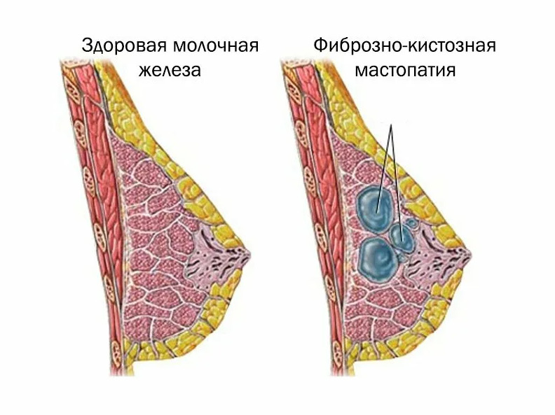 Фиброз груди