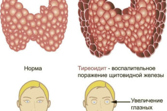 Тиреоидит