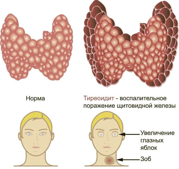 Тиреоидит