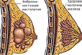 фиброз молочной железы