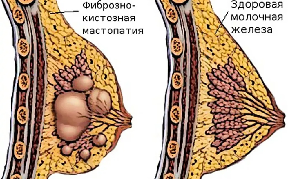 фиброз молочной железы