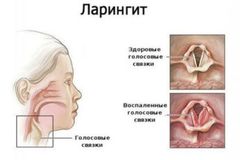 Ларингит