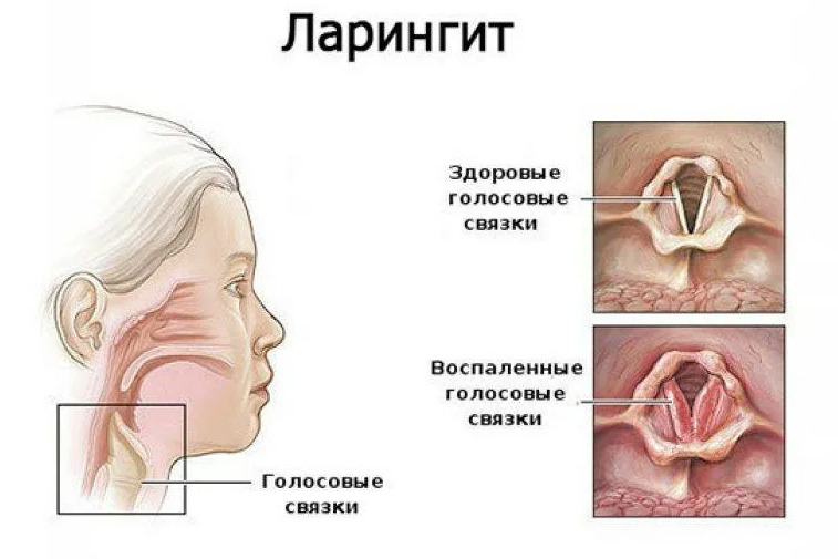 Ларингит