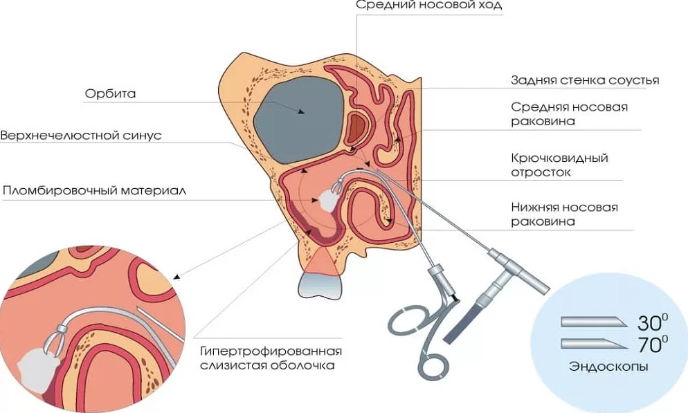 Эндоскопическая операция