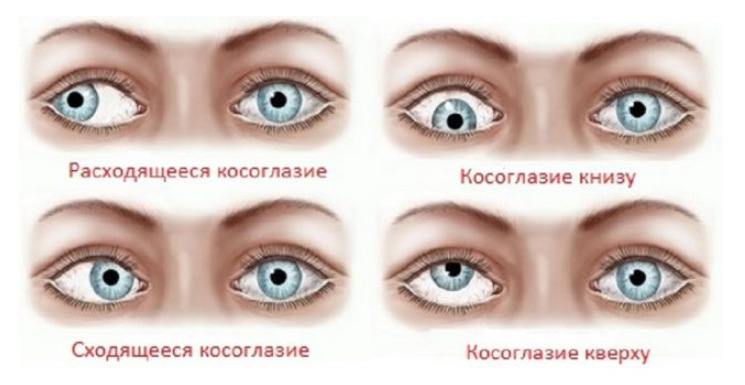 Глазная мигрень: причины болезни, симптомы и способы лечения