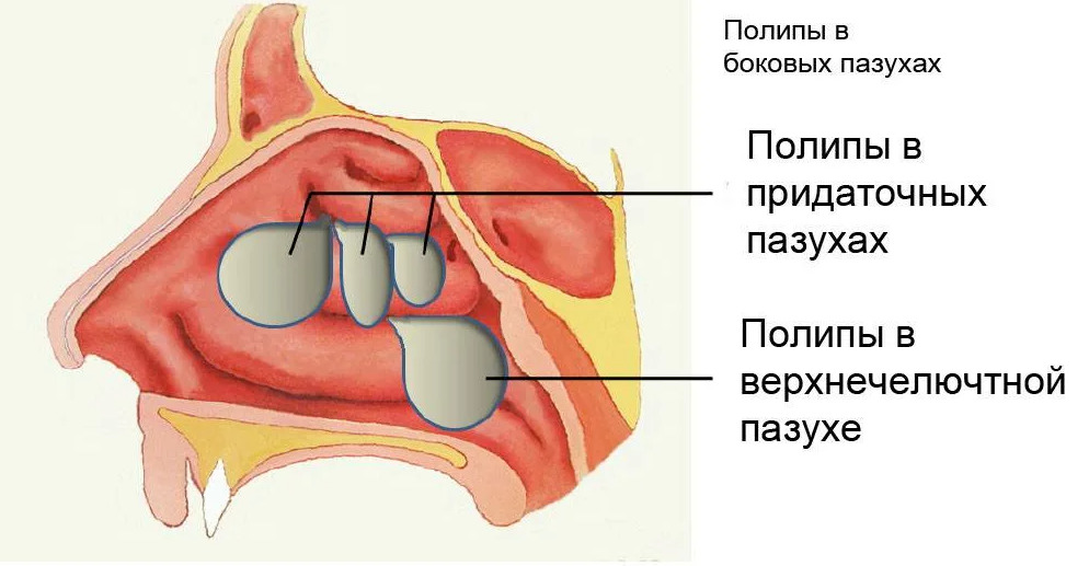 Полипы в носу