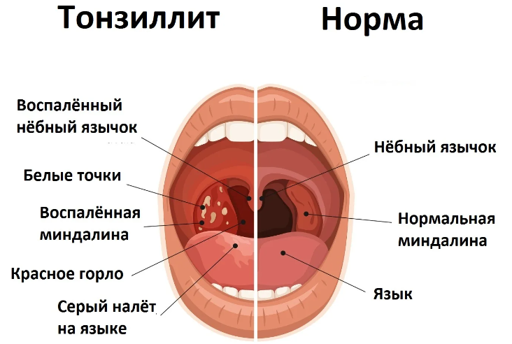 Тонзиллит у ребенка