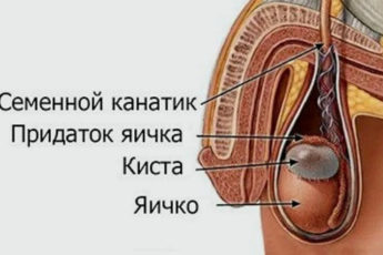 Киста яичка
