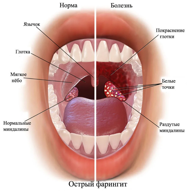 Острый фарингит